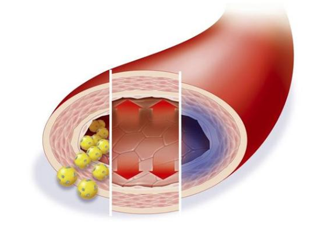 低密度胆固醇超标，多久会影响血管健康？来看看盐城康复医院医生怎么说
